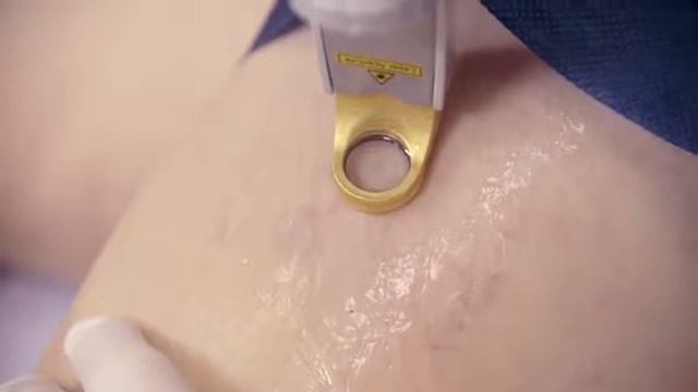 Excel V Laser treatment for leg veins смотреть онлайн