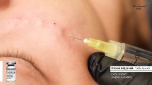 Мезотерапия -техники введения