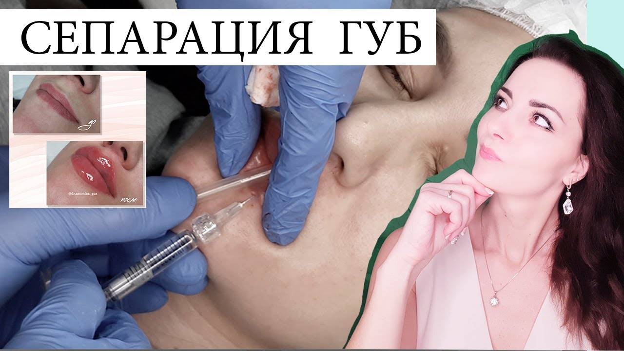 Сепарация УВЕЛИЧЕНИЕ ГУБ 3 вкола /техника губы Анджелины Джоли/ БЬЮТИФИКАЦИЯ ГУБ смотреть онлайн