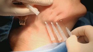 Омоложение лица - мезонити