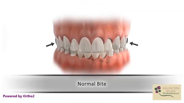 Ортодонтический аппарат Пендулум. Оrthodontic Appliance Pendulum, Pendex, T - Rex, MDA.
