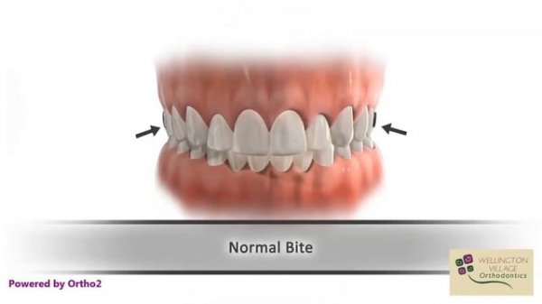 Ортодонтический аппарат Пендулум. Оrthodontic appliance Pendulum, Pendex, T - Rex, MDA.