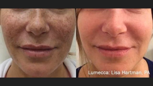 Lumecca Before And Afters