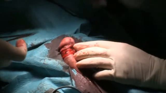 Cirúrgia De Remoção Do Prepúcio - Postectomia,circuncisão