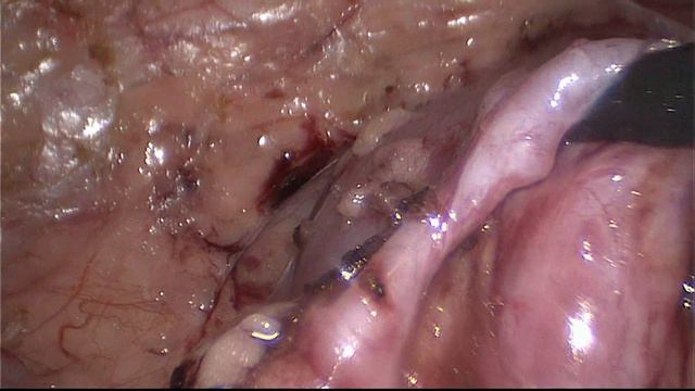 Гидронефроз справа смотреть онлайн