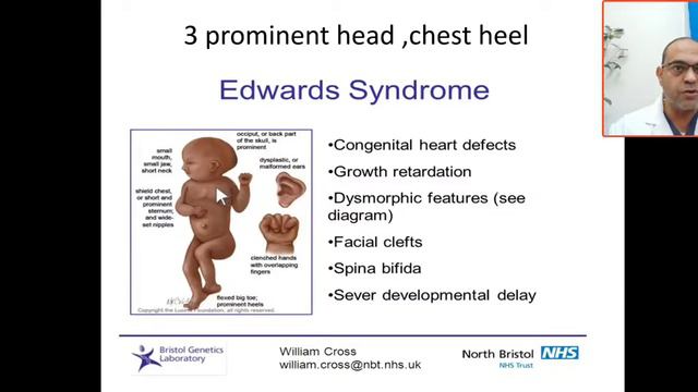 MCQ 19 heart disease 90% common with Edward syndrome, trisomy 18 ,VSD, ASD, coarctation of Aorta смотреть онлайн