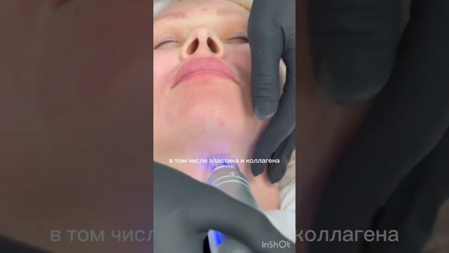 Микроигольчатый RF- лифтинг. Процесс процедуры и его преимущества смотреть онлайн