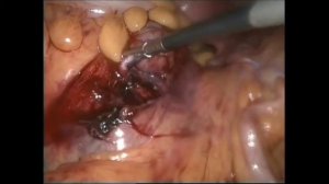 Лапароскопическая резекция кисты малого таза и правого яичника