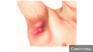 Гидраденит. Как лечить гидраденит.