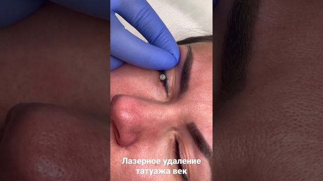 Безопасное лазерное удаление татуажа век с использованием защитных склеральных шильд смотреть онлайн