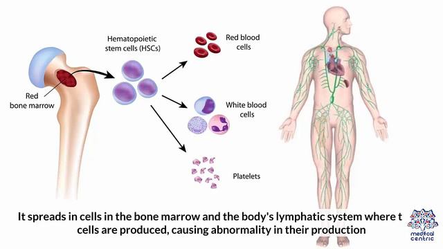 Signs and Symptoms of Leukemia in Adults смотреть онлайн