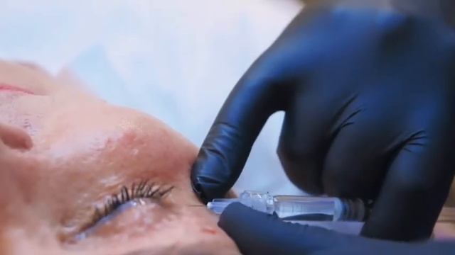 Применение Revi Eye - техника работы и все нюансы биоревитализации.