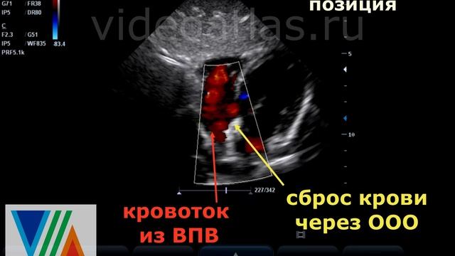 Как отличаются спектры кровотоков из ВПВ и через ООО смотреть онлайн
