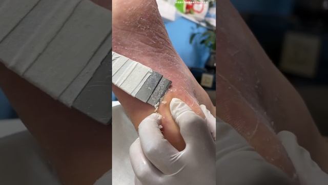 The dead skin on the soles of the feet is thickened and cracked【Foot scalpel】 смотреть онлайн