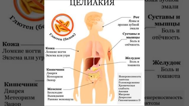 Целиакия