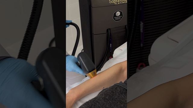 Преимущества лазерной эпиляции на аппарате Soprano Titanium - рассказывает врач | клиника GEN87 смотреть онлайн