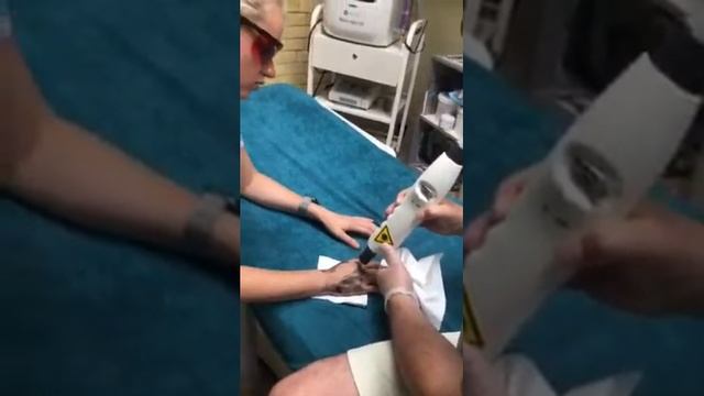 Обучение от центра NO TATTOO омоложению кисти рук лазерным карбоновым пилингом