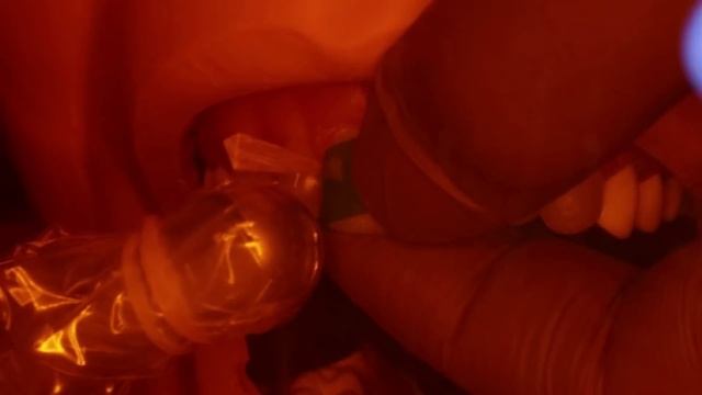 How to fix cavities between front teeth + Dental ASMR (Composite Resin Filling Procedure Explained) смотреть онлайн