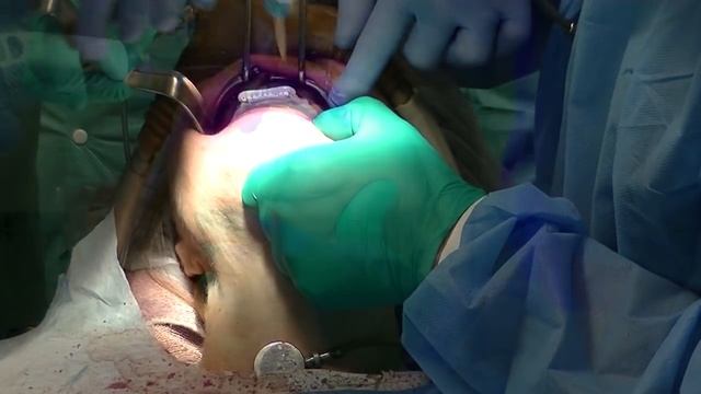 All-on-4® nSequence® Implant Surgical Technique Using Zest Chairside® Attachment Processing Materia смотреть онлайн