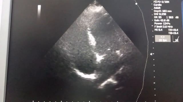 Добавочная хорда левого желудочка смотреть онлайн