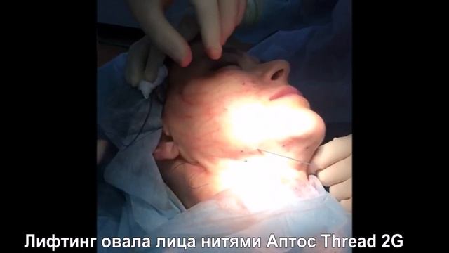 Лифтинг брылей нитями Аптос Thread 2G смотреть онлайн
