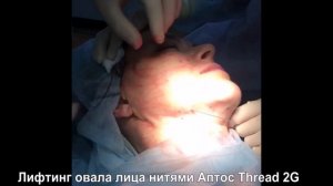 Лифтинг брылей нитями Аптос Thread 2G