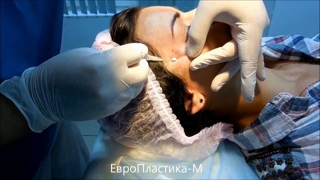 Коррекция резорбтивными нитями области глаз смотреть онлайн