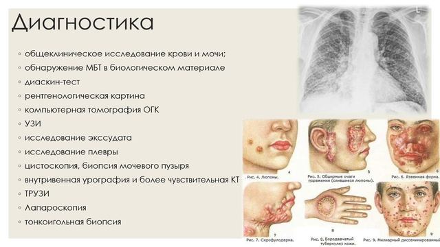 8. Инфекционная патология ч2(Диагностика туберкулеза).mp4 смотреть онлайн