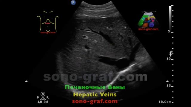 УЗИ - Нижняя Полая Вена смотреть онлайн