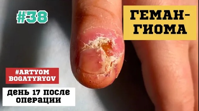 38. Заживление раны, после удаления гемангиомы