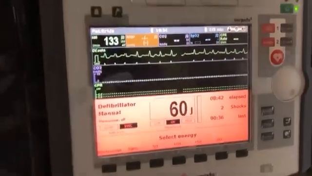 Cardioversion With Corpuls3