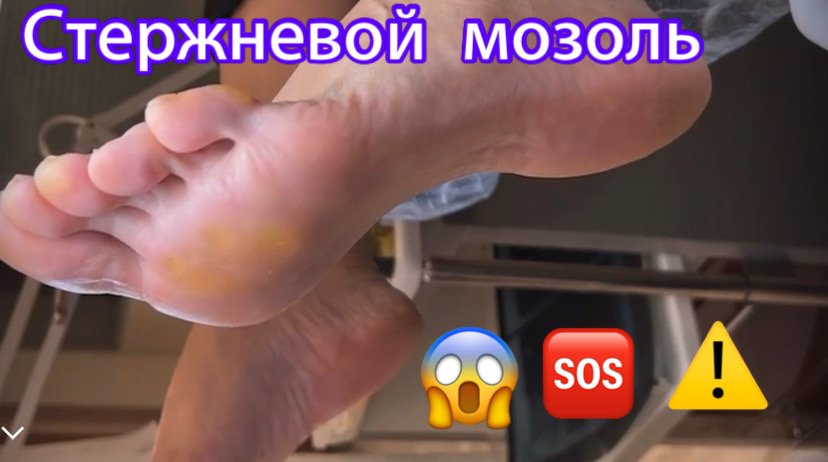 Стержневой мозоль?⚠️❗️? смотреть онлайн