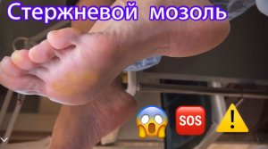 Стержневой мозоль?⚠️❗️?