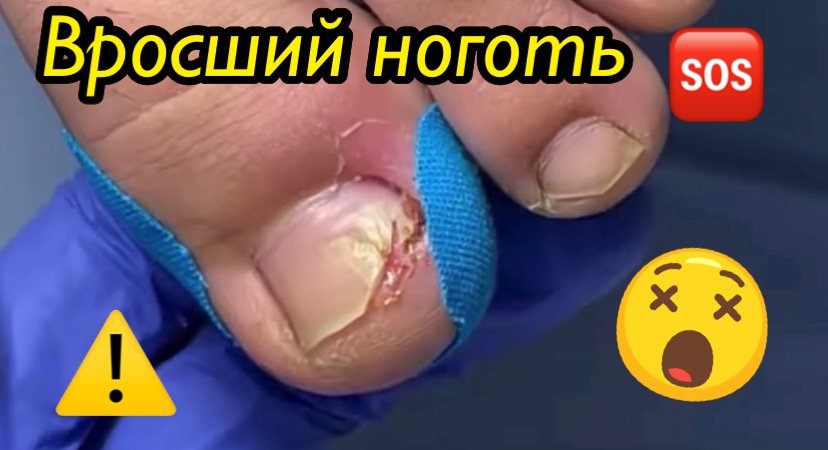 Вросший ноготь???⚠️?