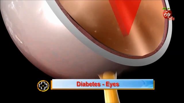 Diabetic Retinopathy in Telugu by Dr. Arun Mukka смотреть онлайн