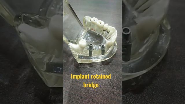 Implant retained bridge |Dental Implant #dental#dentalimplants #familydentalcare смотреть онлайн