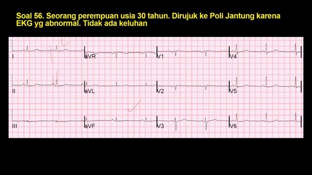 Ada Apa dengan Lead V1 dan V2? Infark Lama? Hipertrofi? Miopati? Atau Normal? смотреть онлайн