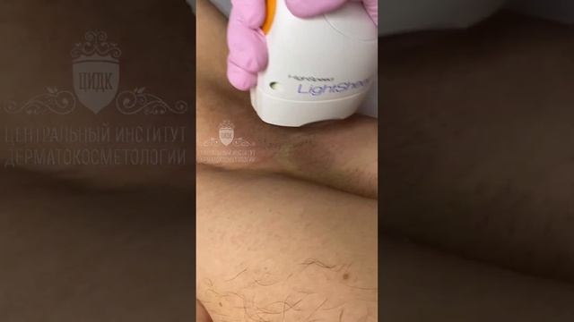 Мужчины тоже делают лазерную эпиляцию смотреть онлайн