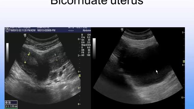 Gynaecological ultrasound part 1 (Jan 2015) - Dr Soha Talaat (In Arabic) смотреть онлайн
