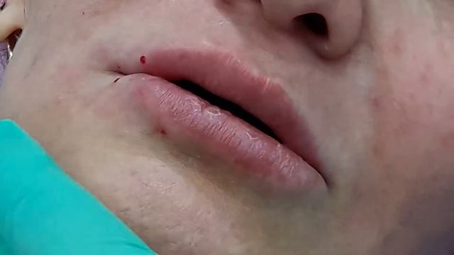 Меди лайт Применение филлеров для изменения формы области губ смотреть онлайн