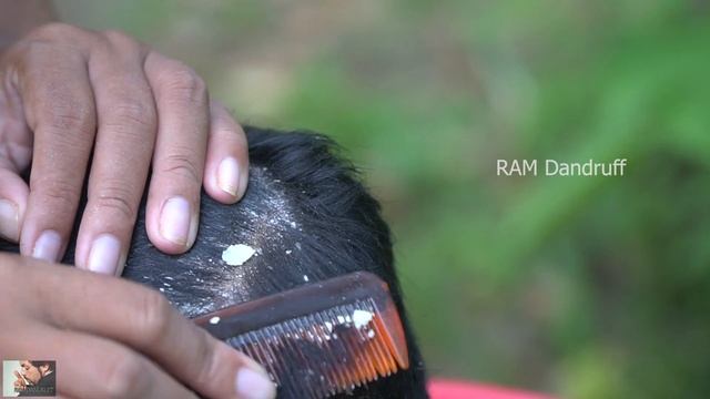 Psoriasis treatment - Dandruff Removal - Itchy Scratching - Huge Flakes, Part 245 смотреть онлайн