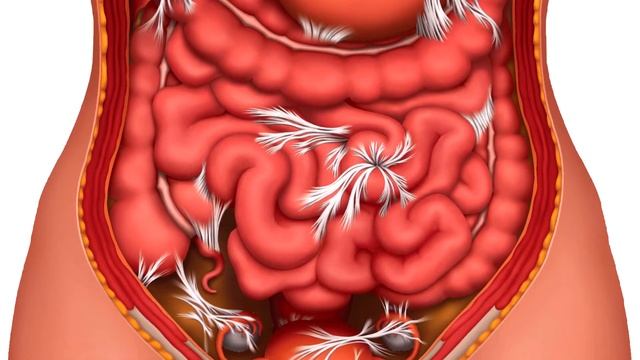 Что такое аппендицит? смотреть онлайн