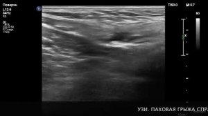 ?️ УЗИ  ПАХОВАЯ ГРЫЖА СПРАВА.mp4