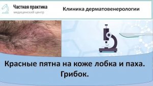 Красные пятна и грибок кожи лобка и паха
