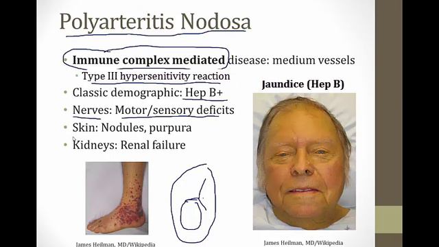 Vasculitis смотреть онлайн