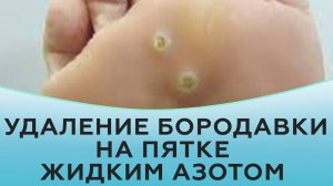 Удаление бородавки на пятке жидким азотом.
