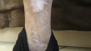 Избавление от трофических язв на ногах возможо?