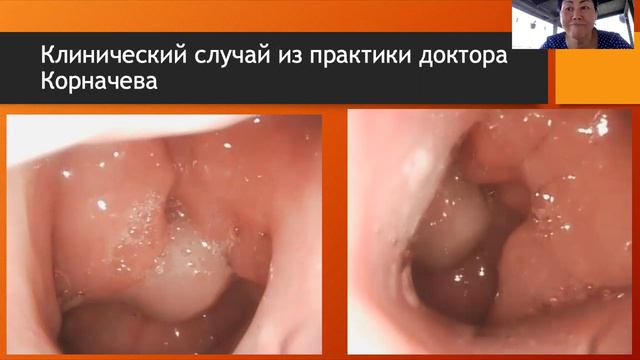 Неэффективность "слепой" аденотомии смотреть онлайн