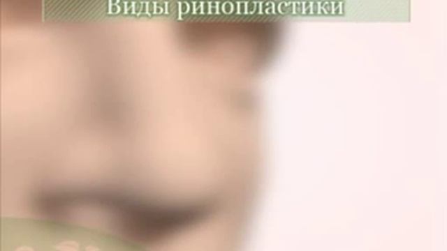 Ринопластика