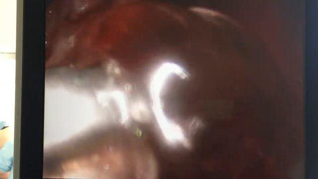 Фиксация ПКС смотреть онлайн